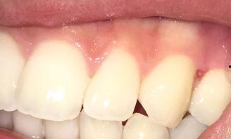 吃瓜牙龈特别疼,揭秘吃瓜背后的真相